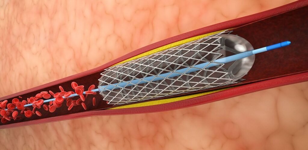 Angioplasty Treatment in Mombasa