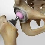 Hip Replacement Surgery in Tanzania