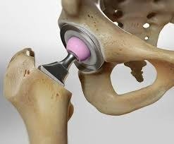 Hip Replacement Surgery in Tanzania