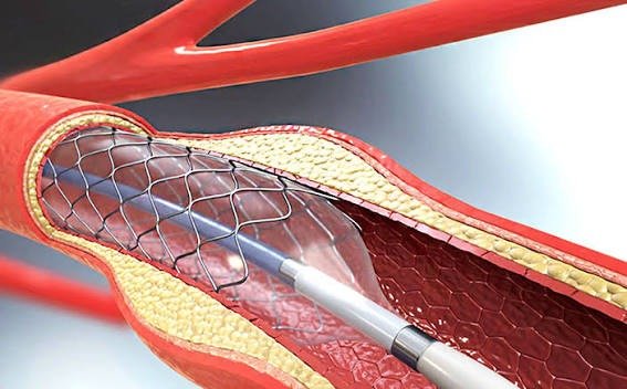 Angioplasty Surgery in Tanzania