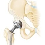 Hip Replacement Specialists in Nairobi