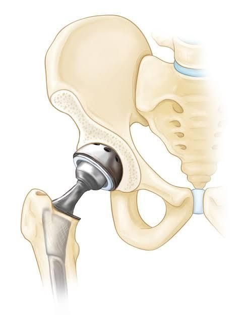 Hip Replacement Specialists in Nairobi