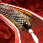 Angioplasty Specialists in Nairobi