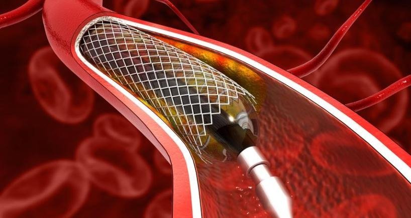 Angioplasty Specialists in Nairobi
